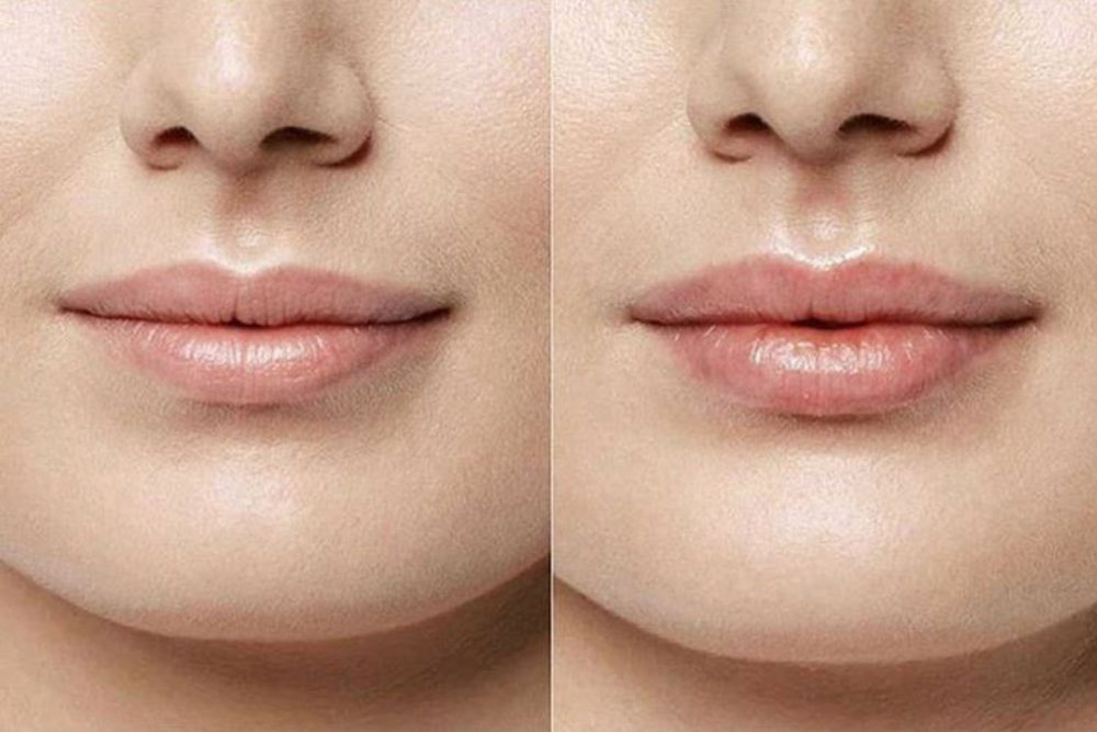 What is the Hyaluron Pen everything you need to know