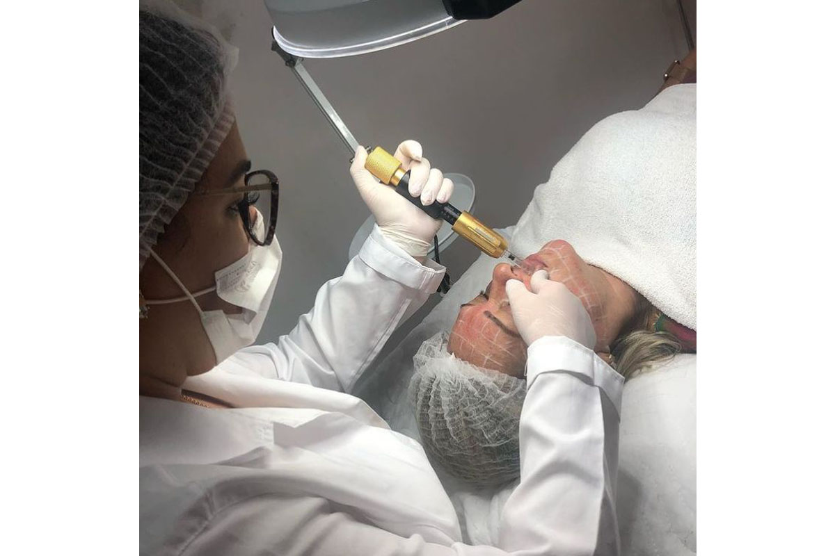 hyaluron pen treatment