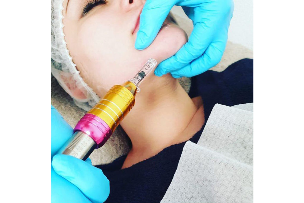 What is the Hyaluron Pen everything you need to know