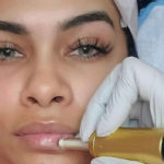 What is the Hyaluron Pen: everything you need to know