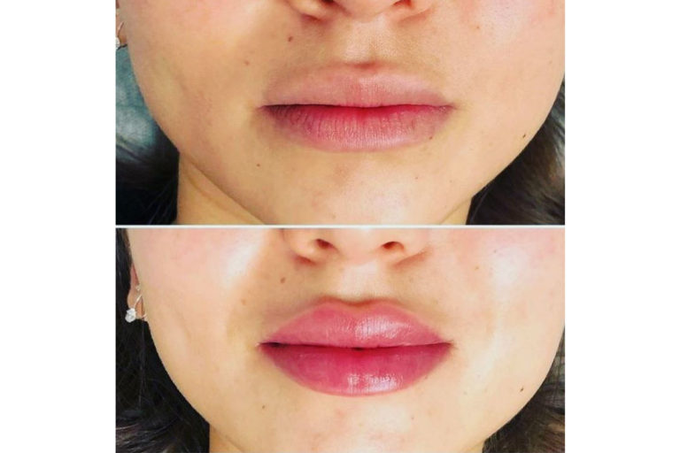 What is the Hyaluron Pen everything you need to know