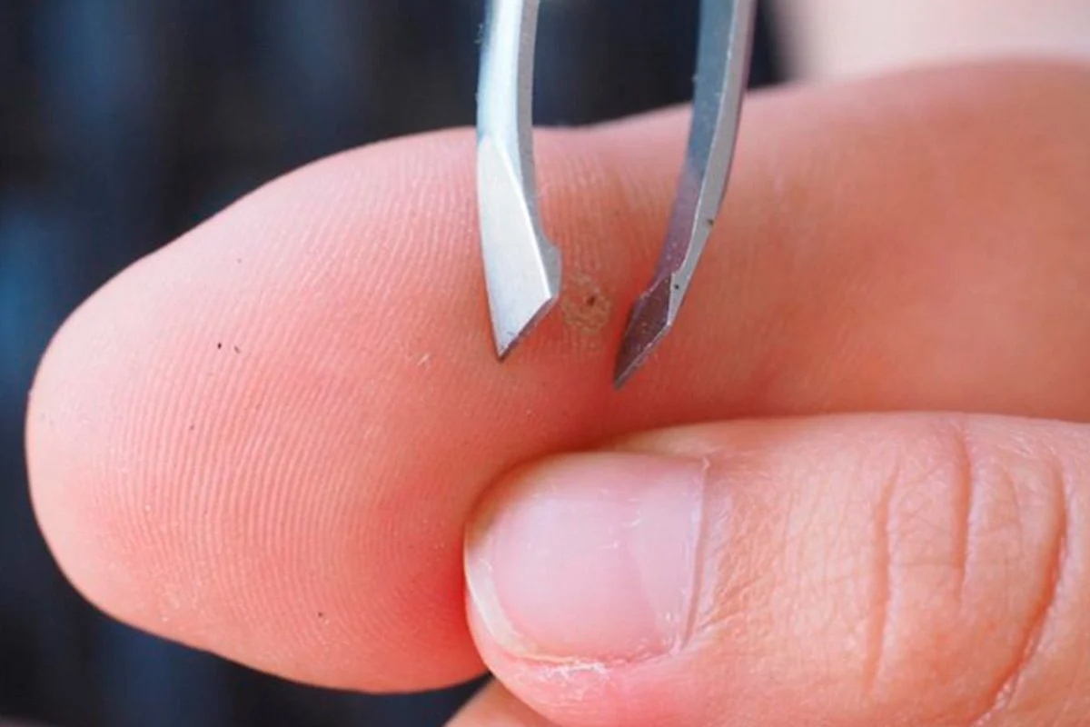 Tweezers Removing Splinter